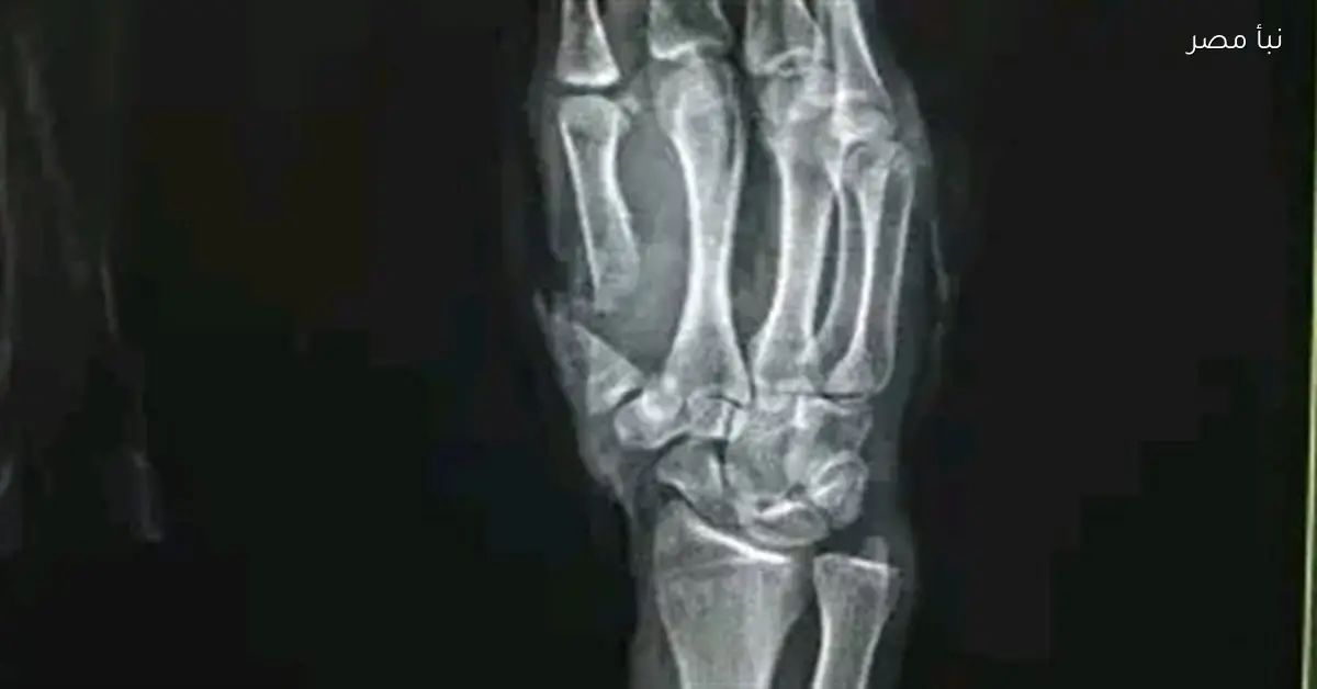 نجاح جديد لمستشفى سوهاج الجامعي بإعادة إصبع الإبهام لشاب في بداية عام 2026