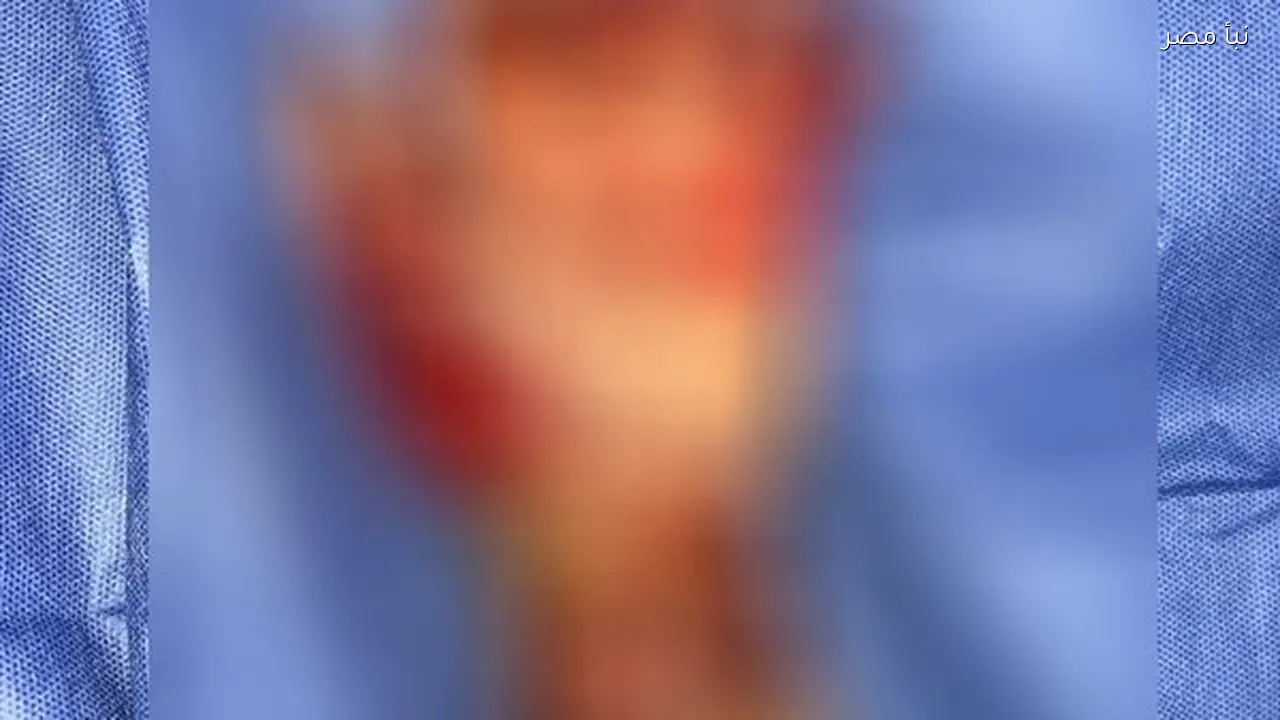 فريق طبي بمستشفى الطوارئ الجديد بجامعة سوهاج ينجح في إنقاذ ذراع طفل بعد إصابة خطيرة بطاحونة قمح