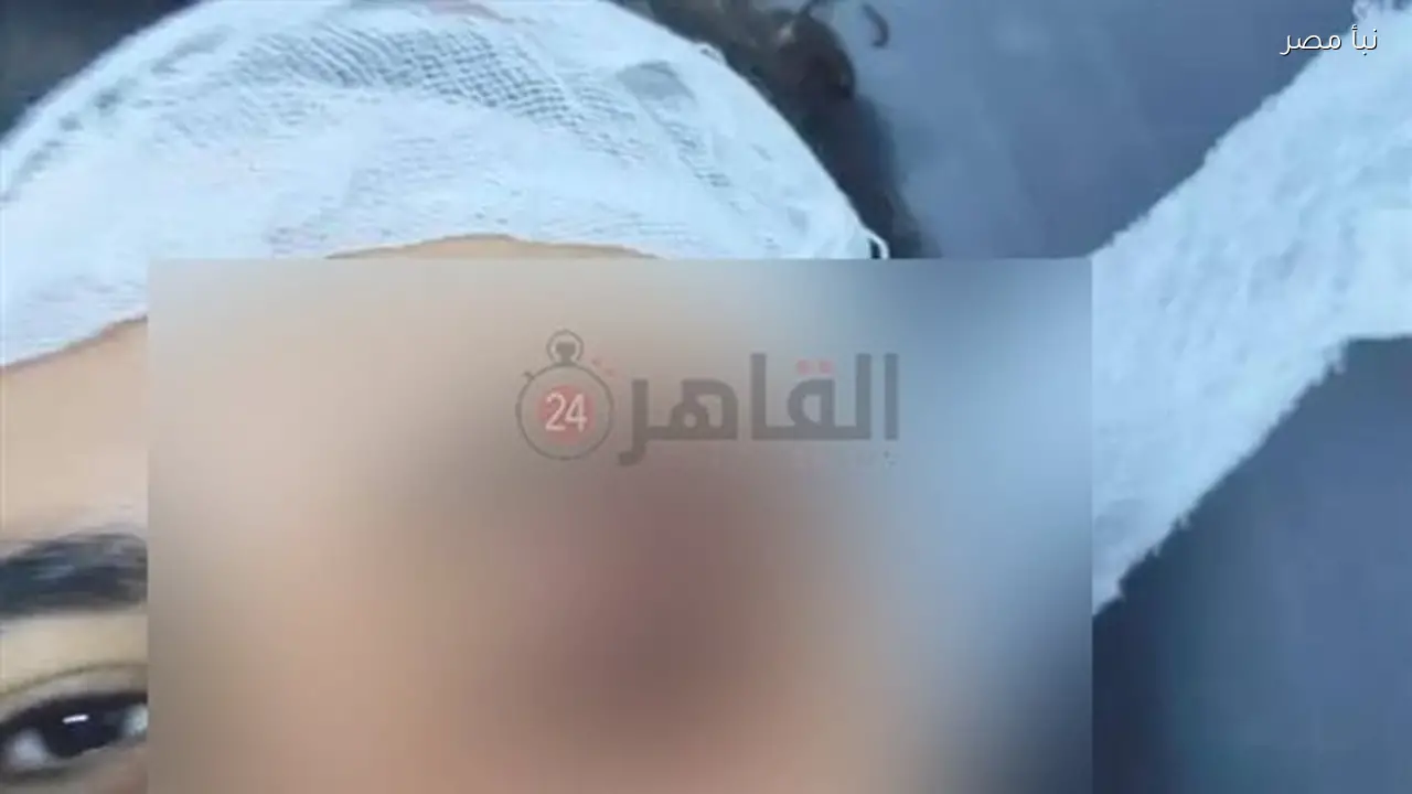 مدير مستشفى الجامعة يوضح الحالة الصحية للعامل المعتدى عليه في فاقوس بعد تعرضه لقطع في عضلات العين