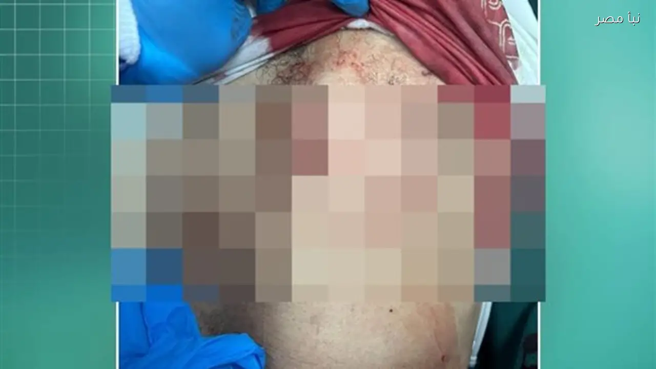 إنقاذ شاب بعد طعنة نافذة في القلب بمستشفى المنصورة الدولي
