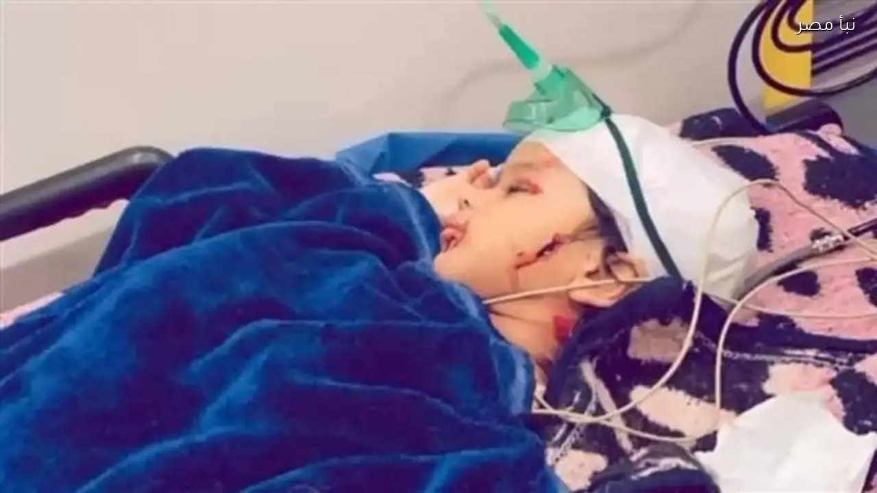 كلب ضال يعقر طفلاً في رأس سدر ويحتاج إلى جراحة طارئة